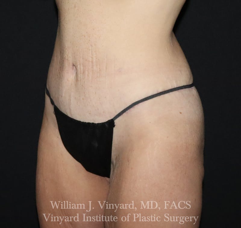 Tummy Tuck Before & After Gallery - Patient 490777 - Image 4