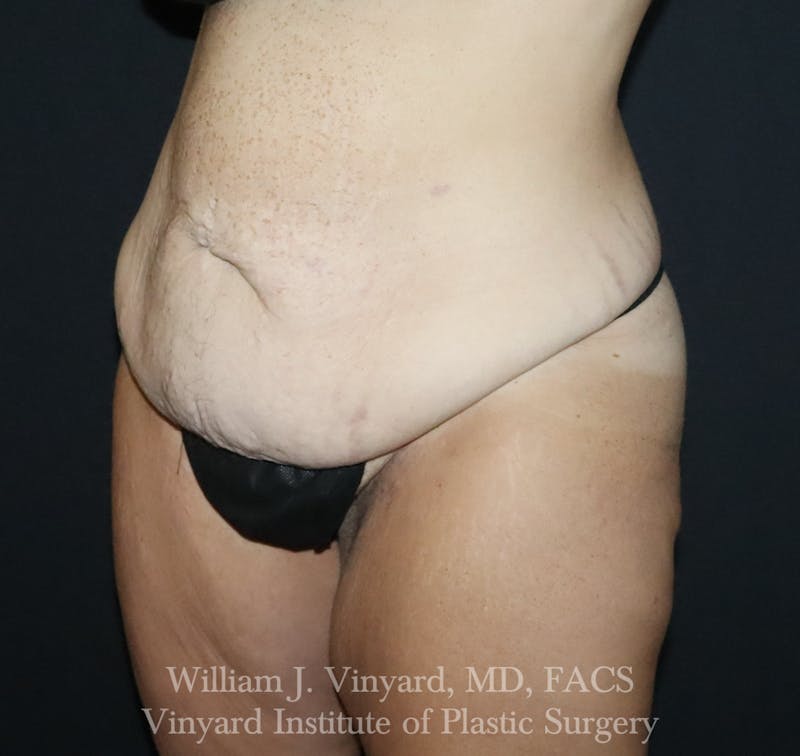 Tummy Tuck Before & After Gallery - Patient 490777 - Image 3