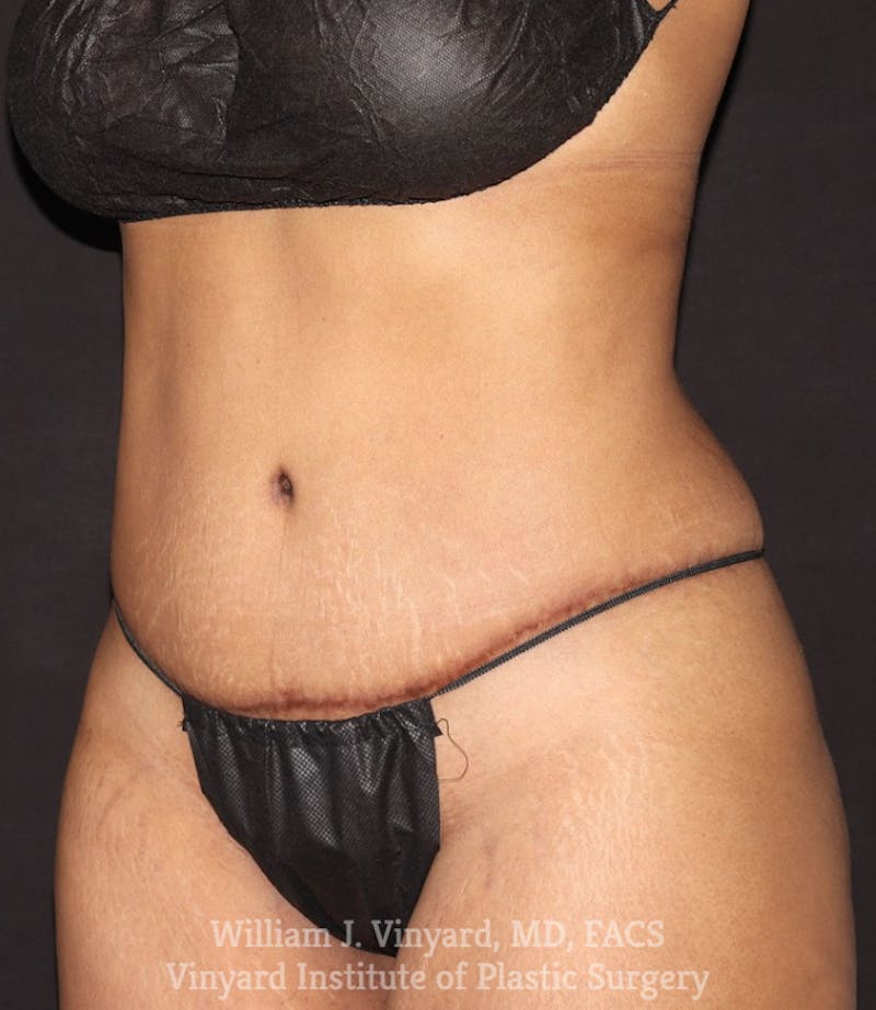 Tummy Tuck Before & After Gallery - Patient 142594 - Image 4