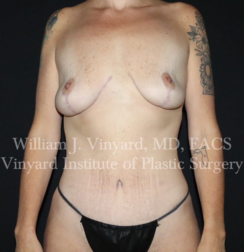 Mommy Makeover Before & After Gallery - Patient 433435 - Image 2