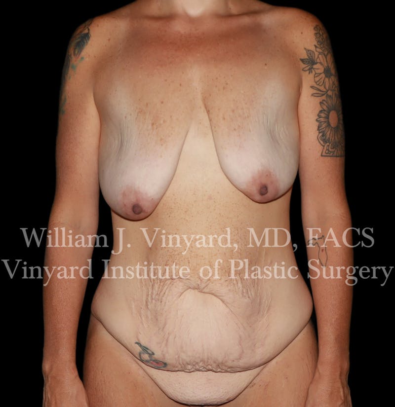 Tummy Tuck Before & After Gallery - Patient 298673 - Image 1