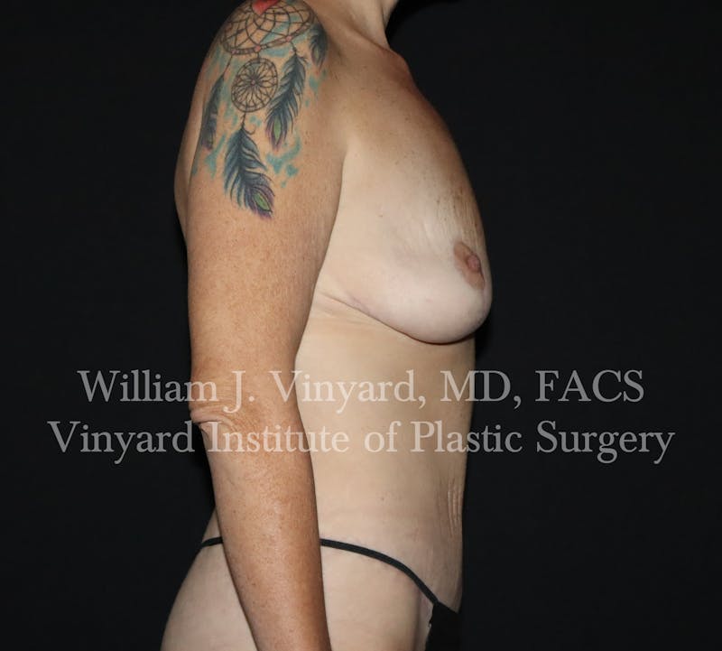Tummy Tuck Before & After Gallery - Patient 298673 - Image 6