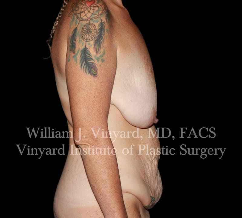 Tummy Tuck Before & After Gallery - Patient 298673 - Image 5