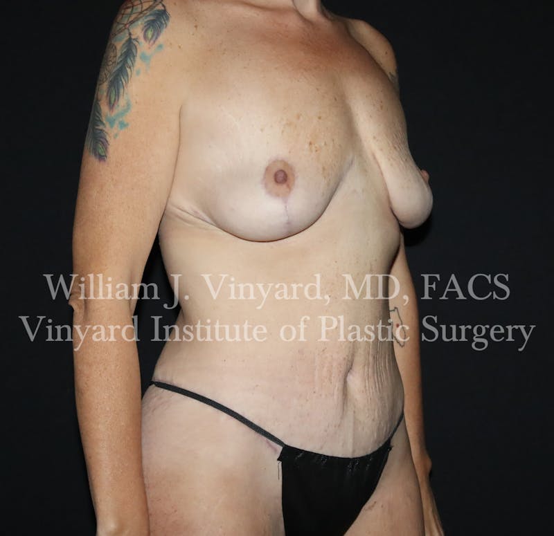 Tummy Tuck Before & After Gallery - Patient 298673 - Image 4