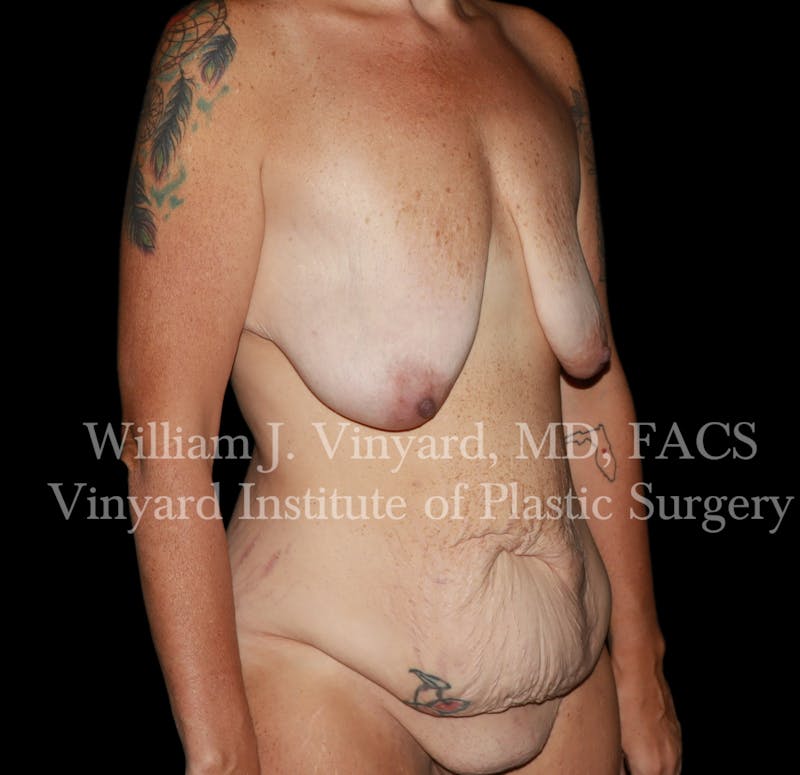 Tummy Tuck Before & After Gallery - Patient 298673 - Image 3