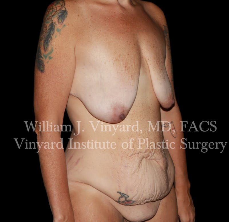 Tummy Tuck Before & After Gallery - Patient 298673 - Image 3