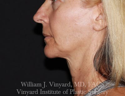 Facetite Before & After Gallery - Patient 188533 - Image 1