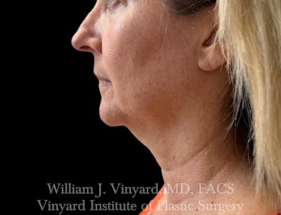 Facetite Before & After Gallery - Patient 188533 - Image 2