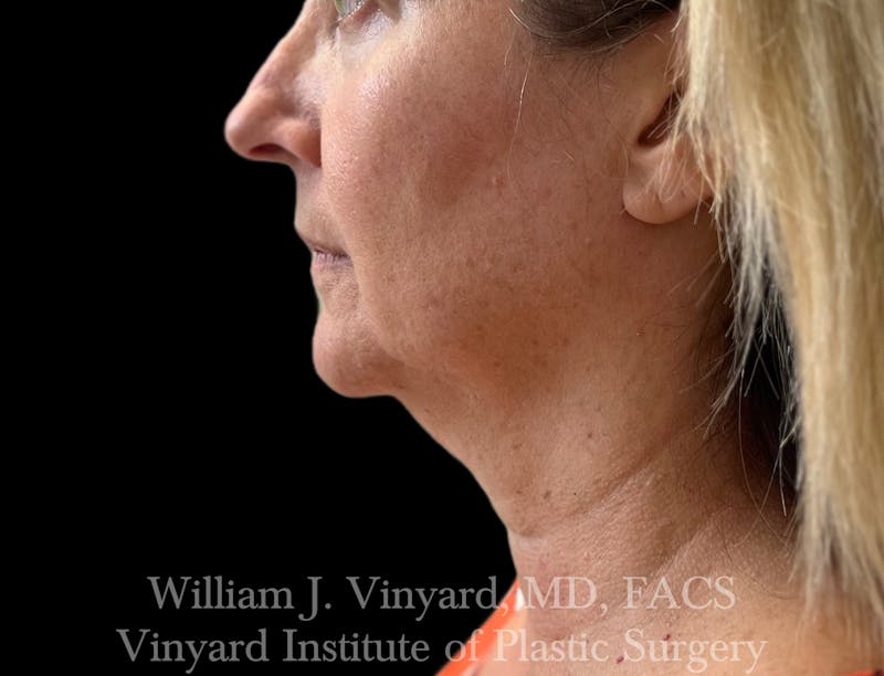 Facetite Before & After Gallery - Patient 188533 - Image 2