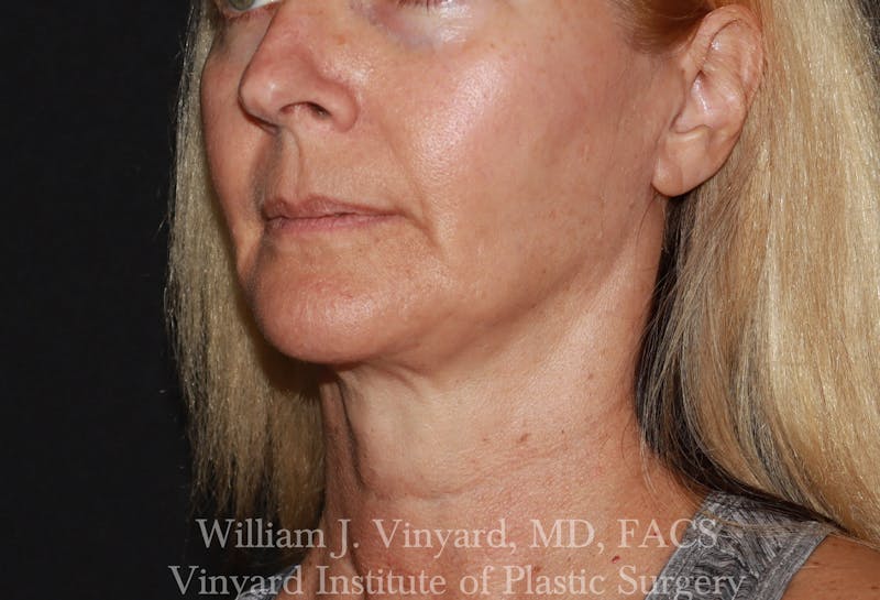 Facetite Before & After Gallery - Patient 188533 - Image 3