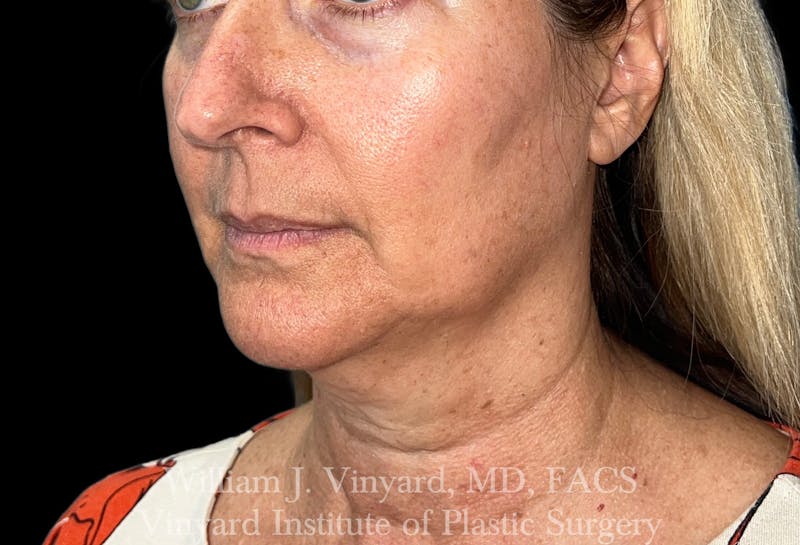 Facetite Before & After Gallery - Patient 188533 - Image 4