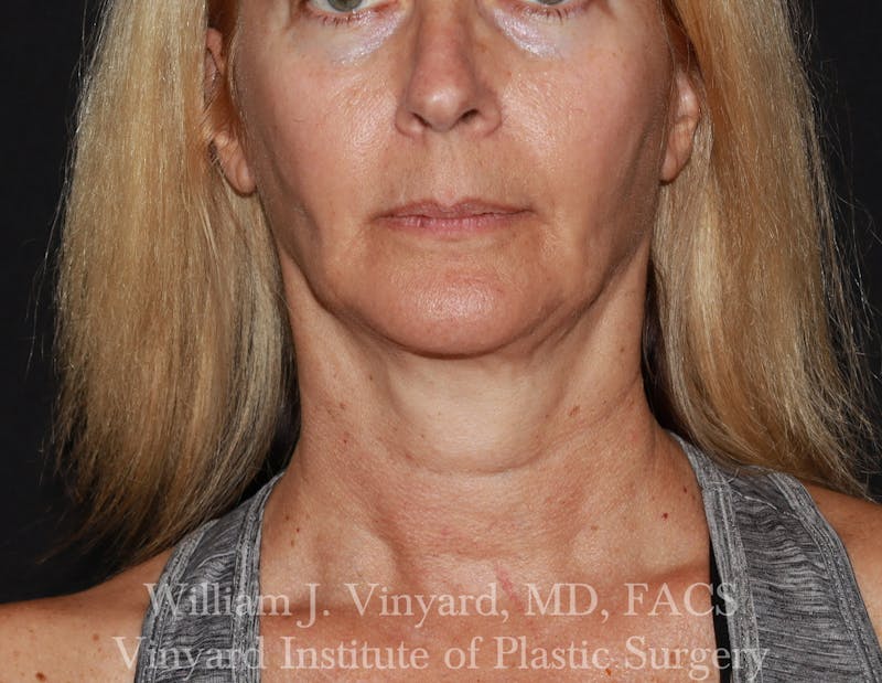 Facetite Before & After Gallery - Patient 188533 - Image 5