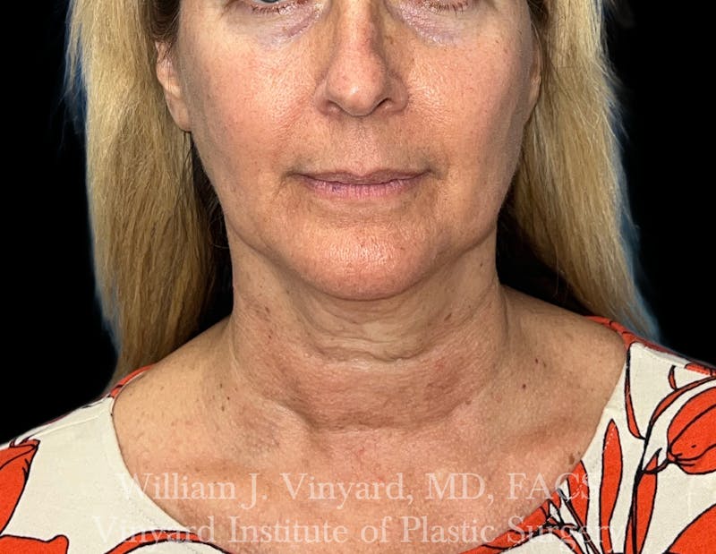 Facetite Before & After Gallery - Patient 188533 - Image 6