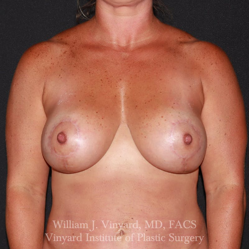 Breast Augmentation + Lift Before & After Gallery - Patient 297533 - Image 2