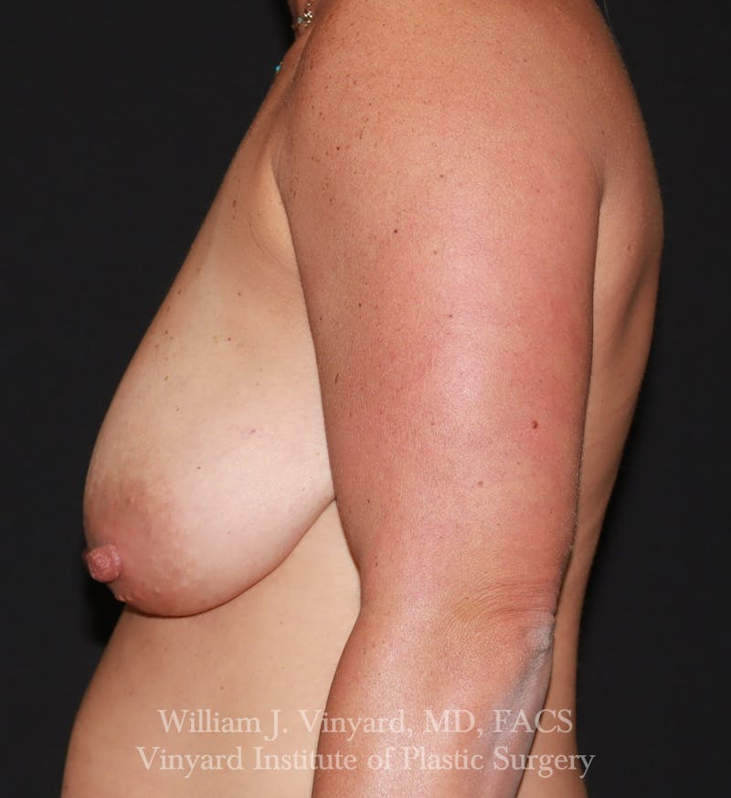 Breast Augmentation + Lift Before & After Gallery - Patient 297533 - Image 5