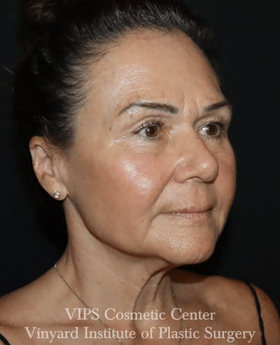 Elluminate Advanced Photofacial w/IPL Before & After Gallery - Patient 592414 - Image 2