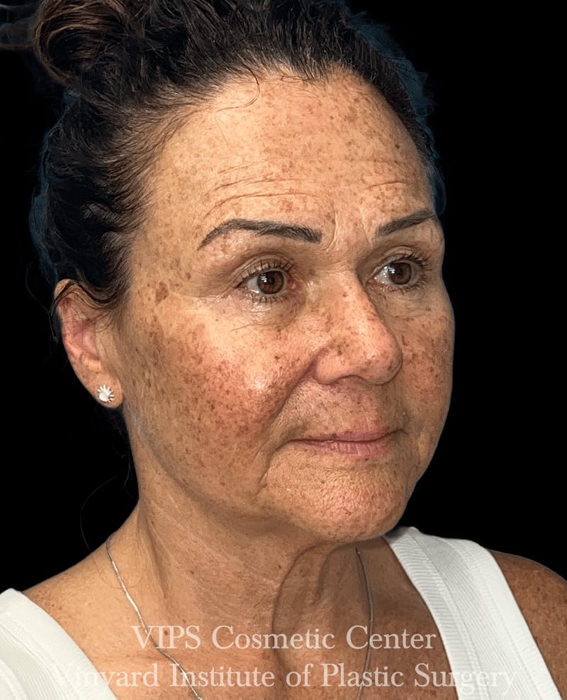 ELLUMINATE WITH IPL Before & After Gallery - Patient 592414 - Image 1