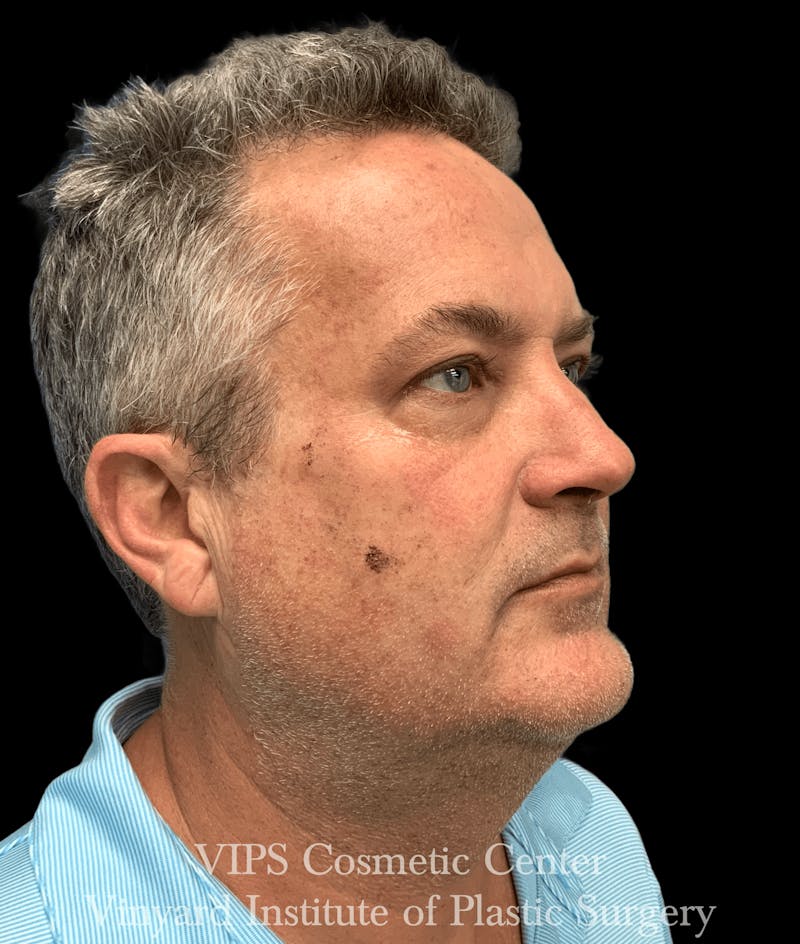 ELLUMINATE WITH IPL Before & After Gallery - Patient 230543 - Image 1