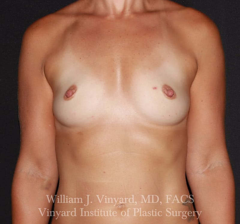 Breast Augmentation Before & After Gallery - Patient 275380 - Image 1