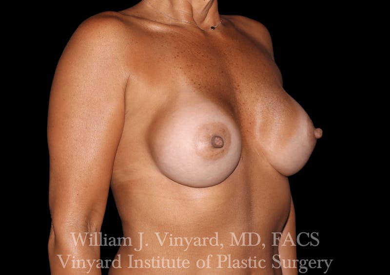 Breast Augmentation Before & After Gallery - Patient 302029 - Image 4