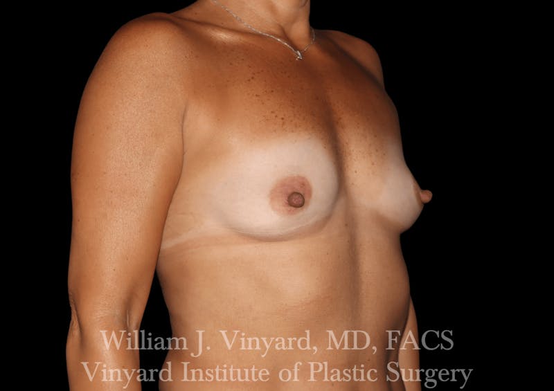 Breast Augmentation Before & After Gallery - Patient 302029 - Image 3