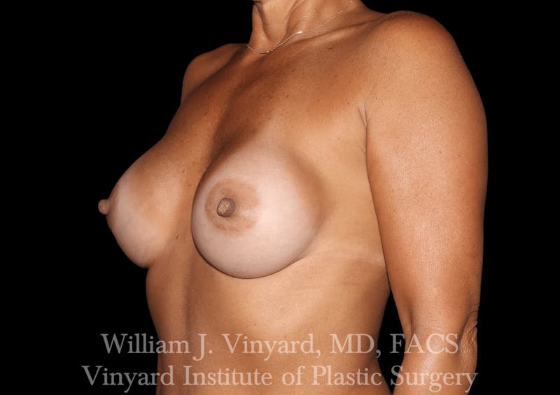 Breast Augmentation Before & After Gallery - Patient 302029 - Image 6