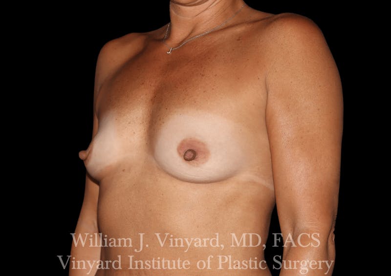 Breast Augmentation Before & After Gallery - Patient 302029 - Image 5