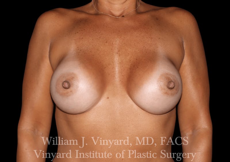 Breast Augmentation Before & After Gallery - Patient 302029 - Image 2