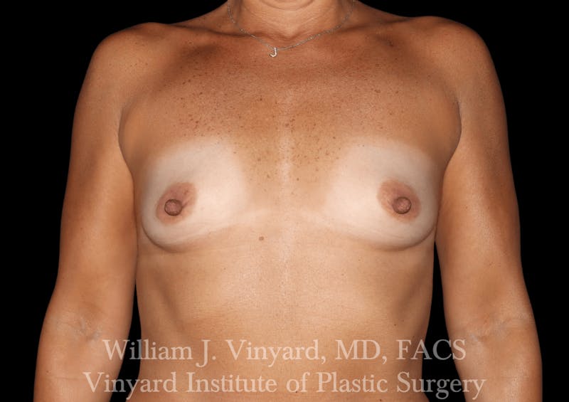 Breast Augmentation Before & After Gallery - Patient 302029 - Image 1