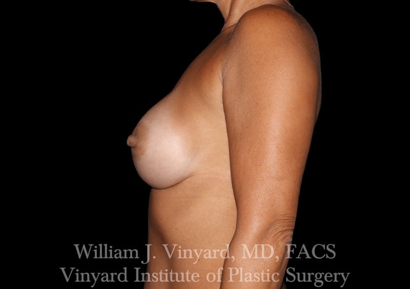 Breast Augmentation Before & After Gallery - Patient 302029 - Image 8