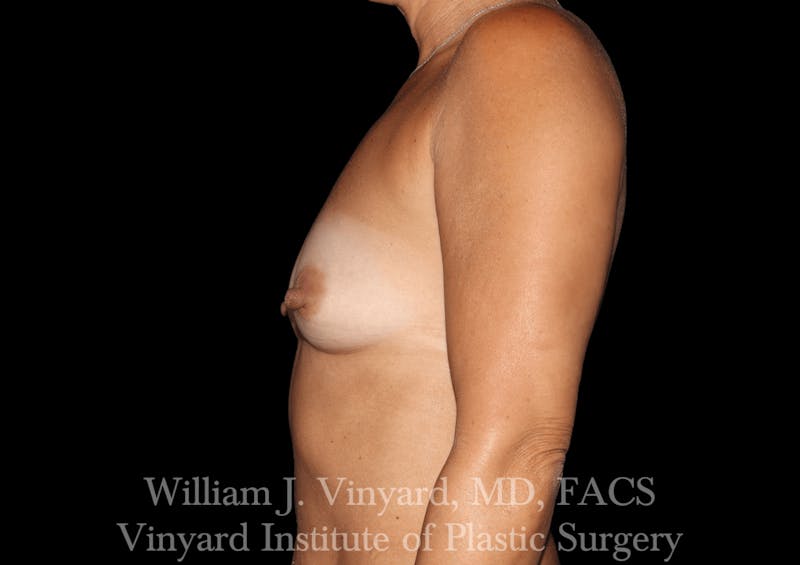 Breast Augmentation Before & After Gallery - Patient 302029 - Image 7