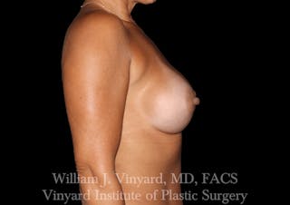 Breast Augmentation Before & After Gallery - Patient 302029 - Image 10