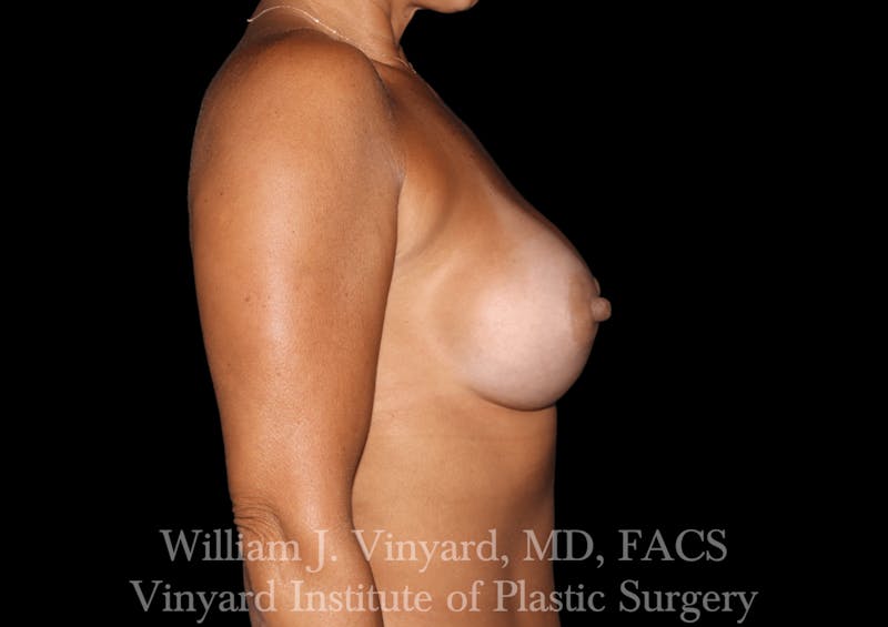 Breast Augmentation Before & After Gallery - Patient 302029 - Image 10