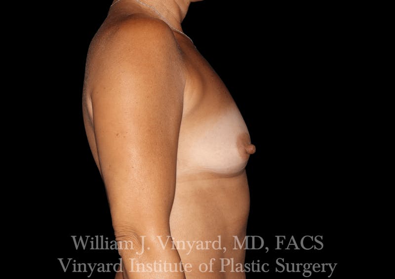 Breast Augmentation Before & After Gallery - Patient 302029 - Image 9