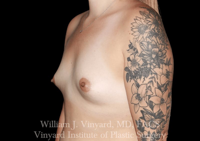 Breast Augmentation Before & After Gallery - Patient 314695 - Image 1