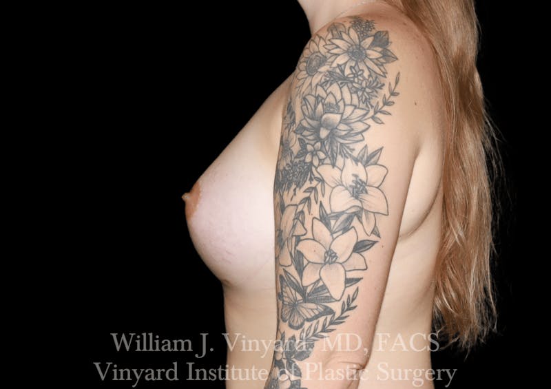 Breast Augmentation Before & After Gallery - Patient 314695 - Image 4