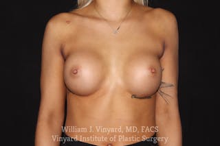Breast Augmentation Before & After Gallery - Patient 501900 - Image 2