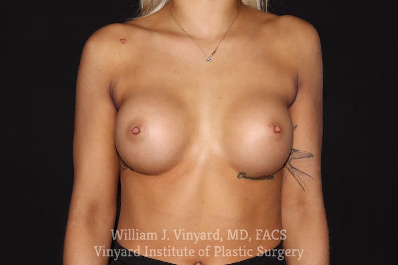 Breast Augmentation Before & After Gallery - Patient 501900 - Image 2