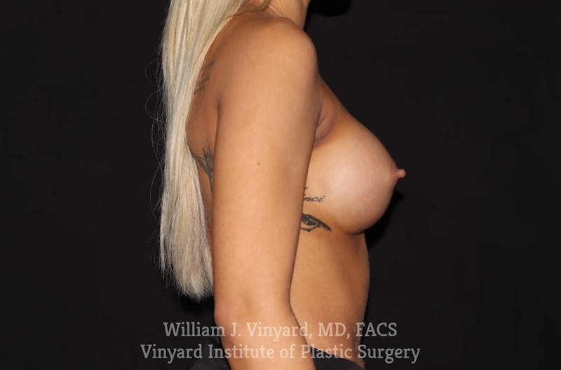 Breast Augmentation Before & After Gallery - Patient 501900 - Image 8