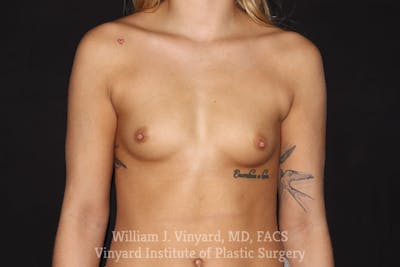 Breast Augmentation Before & After Gallery - Patient 501900 - Image 1