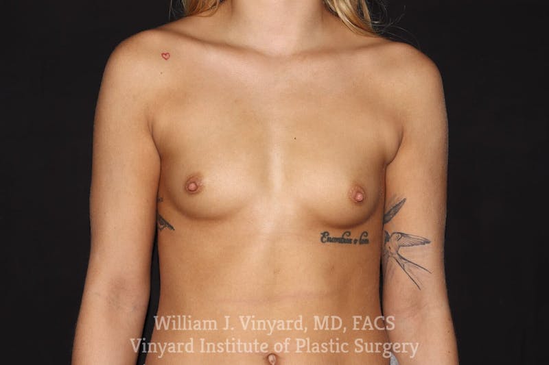 Breast Augmentation Before & After Gallery - Patient 501900 - Image 1