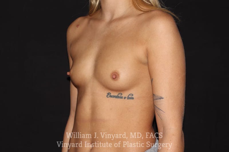 Breast Augmentation Before & After Gallery - Patient 501900 - Image 3