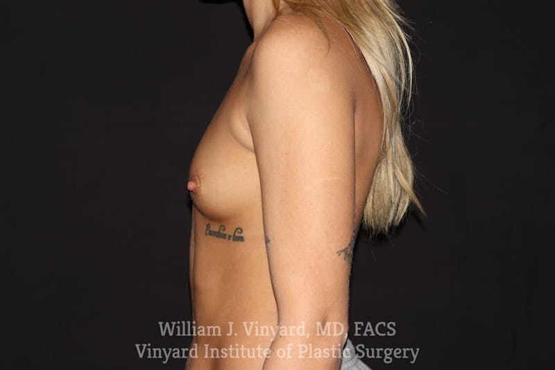 Breast Augmentation Before & After Gallery - Patient 501900 - Image 5