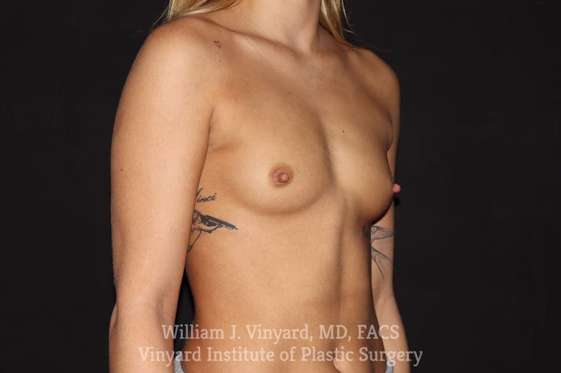 Breast Augmentation Before & After Gallery - Patient 501900 - Image 9