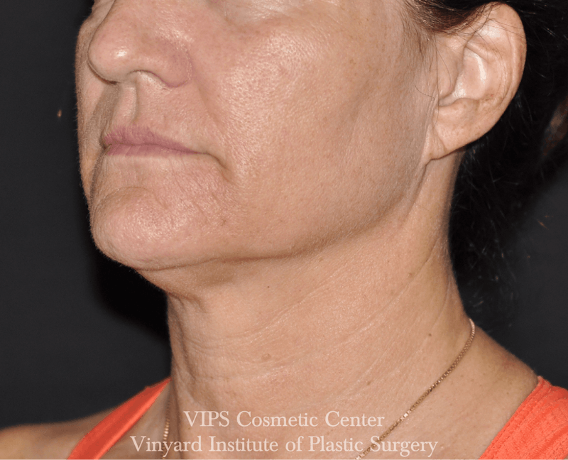 RF Microneedling Morpheus 8 Before & After Gallery - Patient 225060 - Image 2