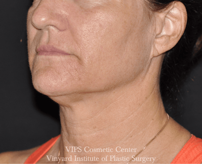 Morpheus8 RF Microneedling Before & After Gallery - Patient 225060 - Image 2