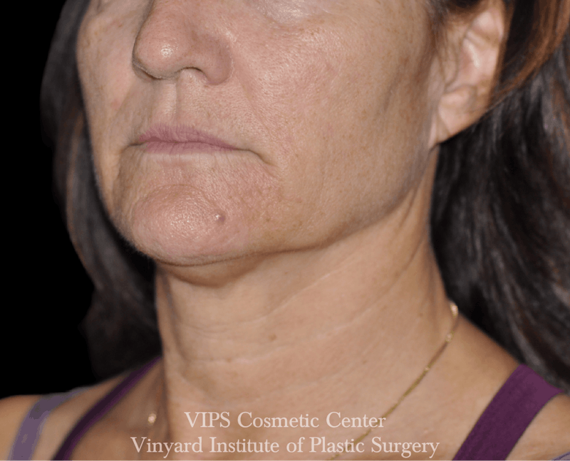 RF Microneedling Morpheus 8 Before & After Gallery - Patient 225060 - Image 1