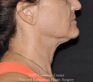 RF Microneedling Morpheus 8 Before & After Gallery - Patient 225060 - Image 4