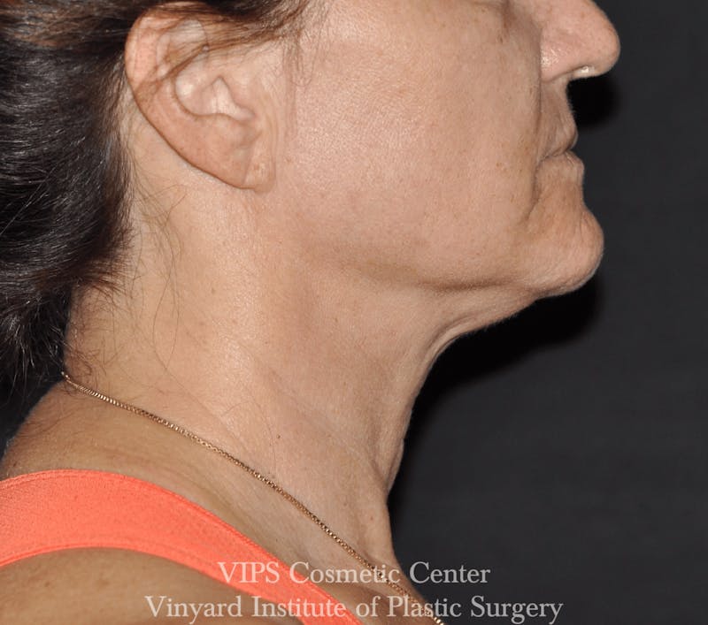 RF Microneedling Morpheus 8 Before & After Gallery - Patient 225060 - Image 4