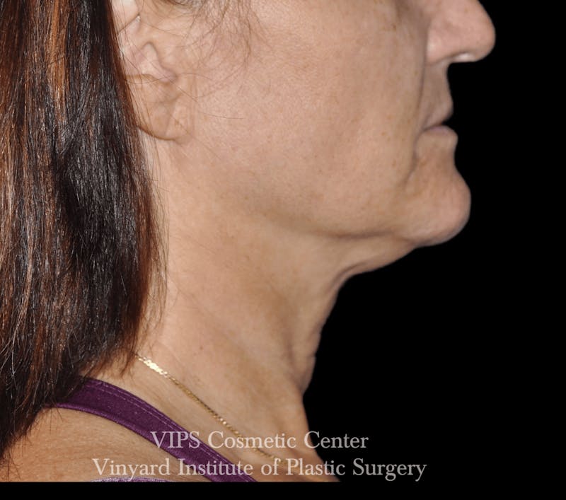 RF Microneedling Morpheus 8 Before & After Gallery - Patient 225060 - Image 3